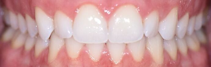 Invisalign Case 8 - Nursery, TX - Before