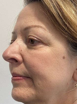 Eyelid Lift: Case 23 Eyelid Lift and Mini Browlift, Ridgefield, CT - Before