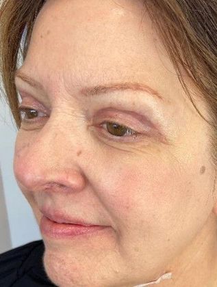 Eyelid Lift: Case 23 Eyelid Lift and Mini Browlift, Ridgefield, CT - After