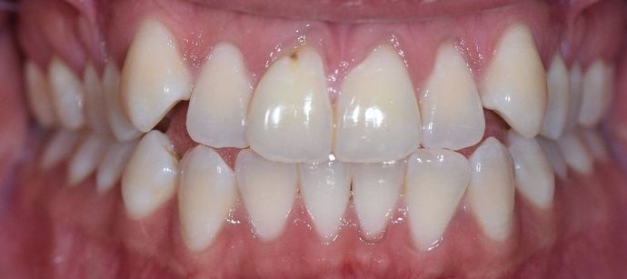 Invisalign: Case 10 - Victoria, TX - Before 2241