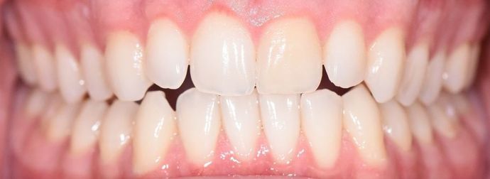 Invisalign: Case 11 - Yorktown, Tx - Before 2890