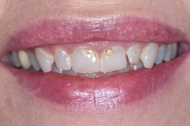 Porcelain Veneers Case 2 - Victoria, TX - Before