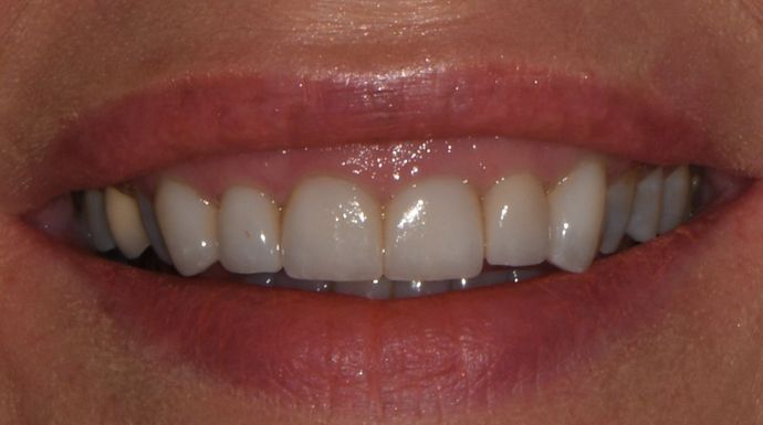 Porcelain Veneers Case 2 - Victoria, TX - After