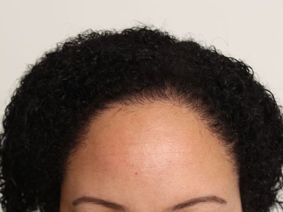 Hair Transplant - Female: Hairline FUT (14) - After female FUT hair transplant