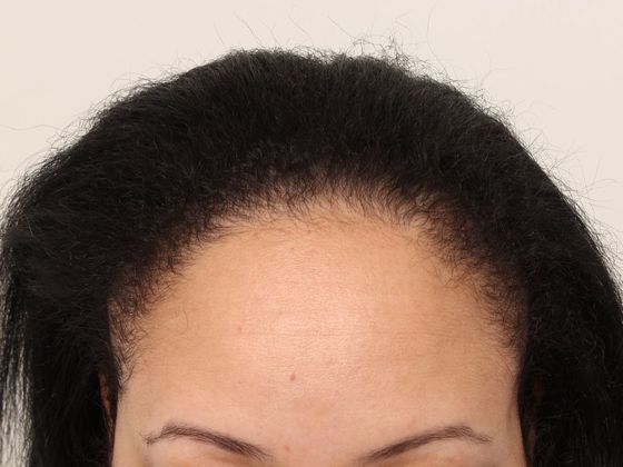 Hairline Fut 14 Female Before And After Hair Transplant Photos Before And After Gallery