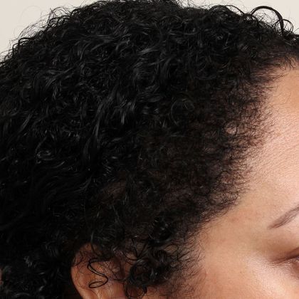 Hair Transplant - Female: Hairline FUT (14) - After