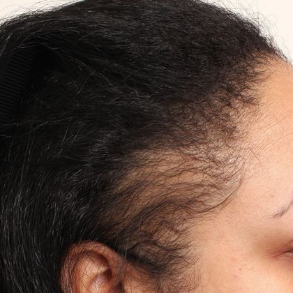 Hair Transplant - Female: Hairline FUT (14) - Before female FUT hair transplant