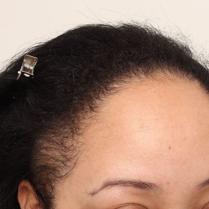 Hair Transplant - Female: Hairline FUT (14) - Before female FUT hair transplant