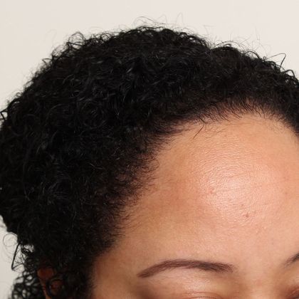 Hair Transplant - Female: Hairline FUT (14) - After female FUT hair transplant