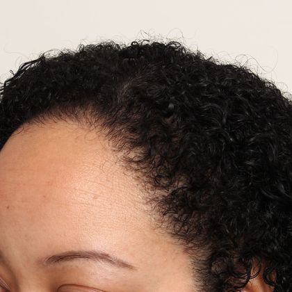 Hair Transplant - Female: Hairline FUT (14) - After female FUT hair transplant