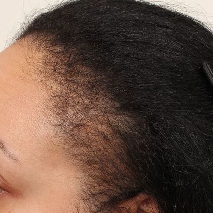 Hair Transplant - Female: Hairline FUT (14) - Before female FUT hair transplant
