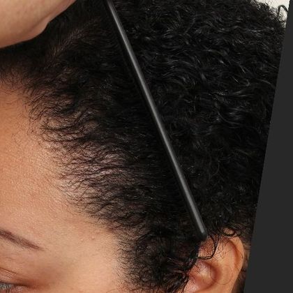 Hair Transplant - Female: Hairline FUT (14) - After female FUT hair transplant