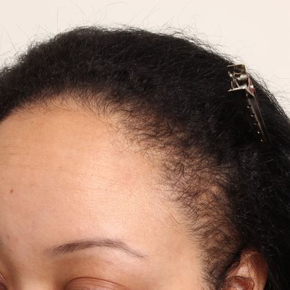 Hair Transplant - Female: Hairline FUT (14) - Before female FUT hair transplant