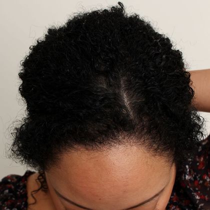 Hair Transplant - Female: Hairline FUT (14) - After female FUT hair transplant