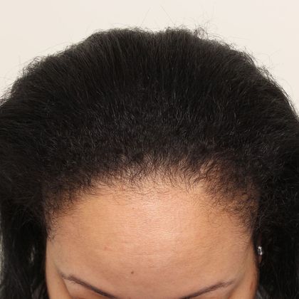 Hair Transplant - Female: Hairline FUT (14) - Before female FUT hair transplant
