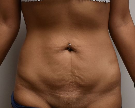 Tummy Tuck (Abdominoplasty): Case 263 - Before
