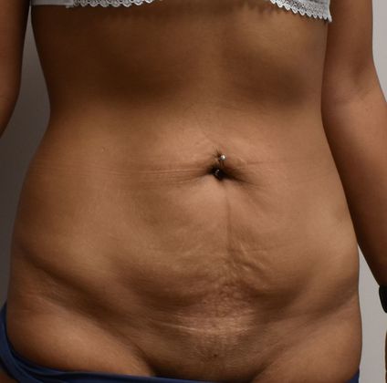 Tummy Tuck (Abdominoplasty): Case 263 - Before