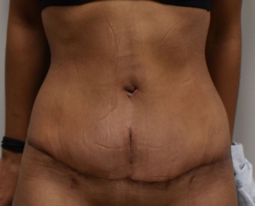 Tummy Tuck (Abdominoplasty): Case 263 - After
