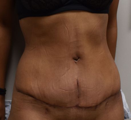 Tummy Tuck (Abdominoplasty): Case 263 - After