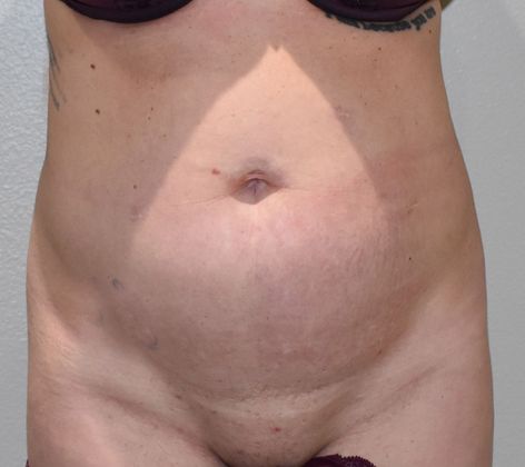 Tummy Tuck (Abdominoplasty): Case 264 - Before