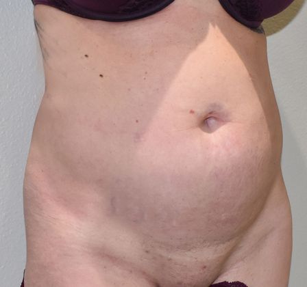 Tummy Tuck (Abdominoplasty): Case 264 - Before