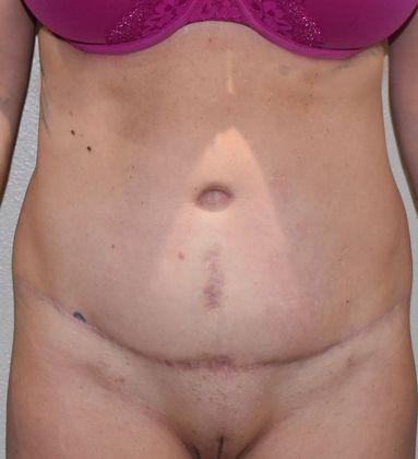 Tummy Tuck (Abdominoplasty): Case 264 - After
