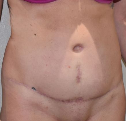 Tummy Tuck (Abdominoplasty): Case 264 - After