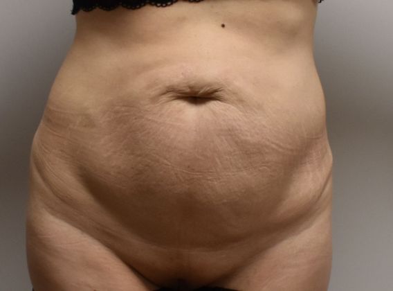 Tummy Tuck (Abdominoplasty): Case 265 - Before