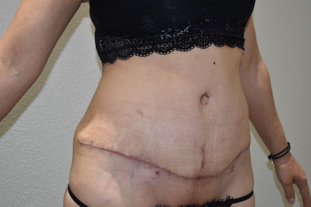 Tummy Tuck (Abdominoplasty): Case 265 - After