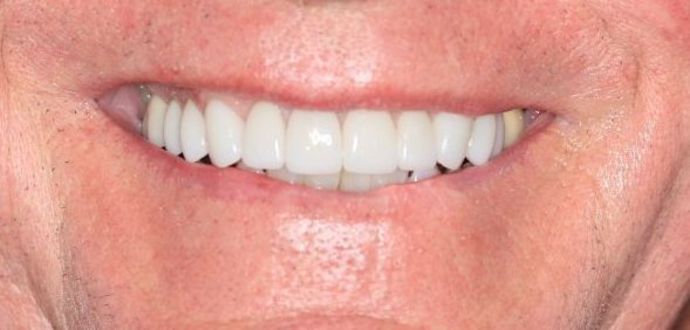 Porcelain Veneers: Case 9 - After