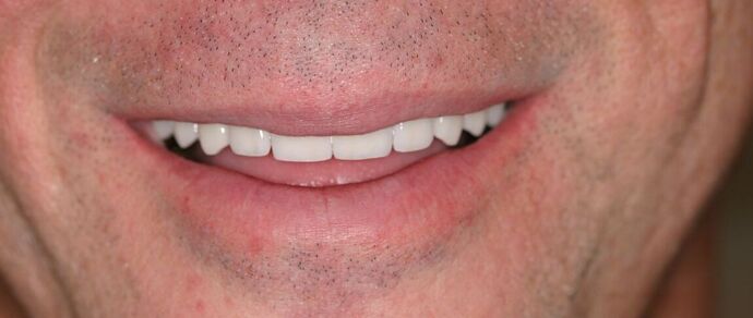 Porcelain Veneers: Case 1 - After Veneers
