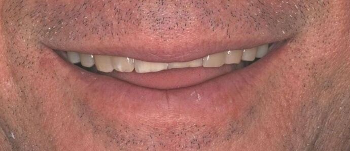 Porcelain Veneers: Case 1 - Before Veneers