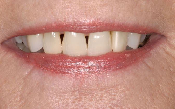 Porcelain Veneers Case 2 - Before