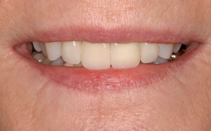 Porcelain Veneers Case 2 - After