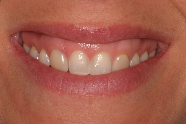 Porcelain Veneers: Case 6 - Before Veneers