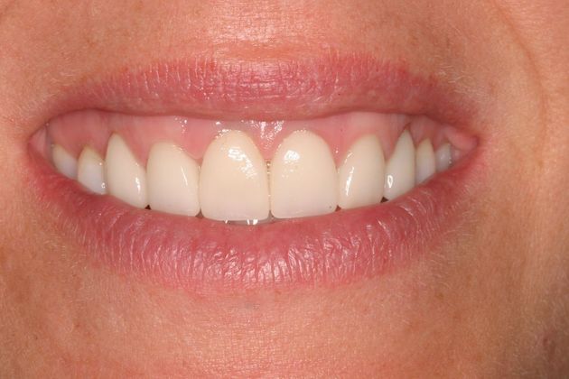 Porcelain Veneers: Case 6 - After Veneers