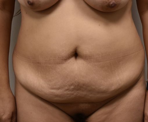 Tummy Tuck (Abdominoplasty): Case 266 - Before