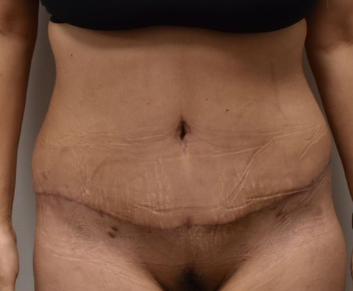 Tummy Tuck (Abdominoplasty): Case 266 - After