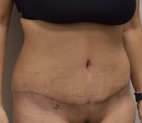 Tummy Tuck (Abdominoplasty): Case 266 - After