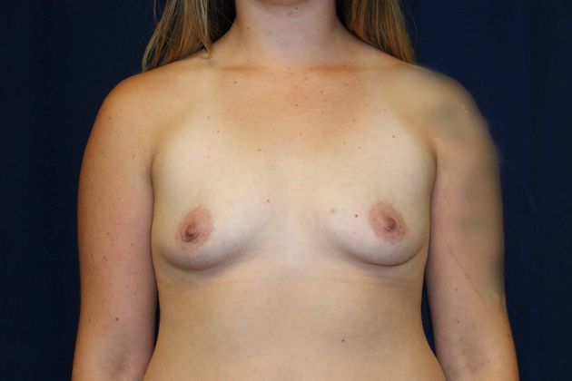 Breast Augmentation*: Case 59 - Before