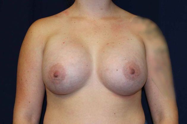 Breast Augmentation*: Case 59 - After
