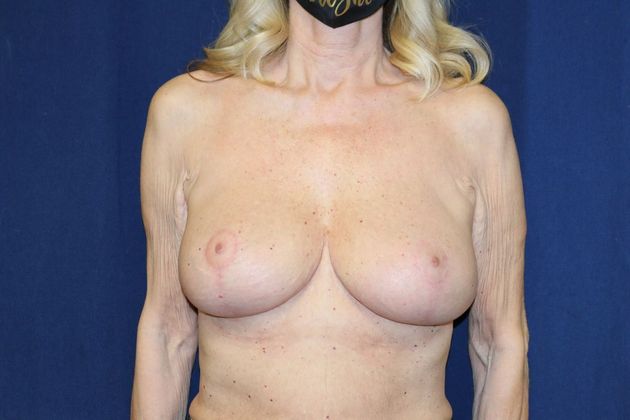 Breast Implant Removal and Exchange Case 13 - After