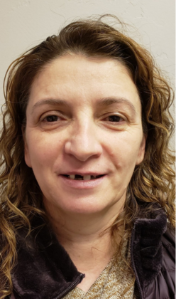 All-on-X Dental Implants: Bukurije's Dental Implants Syracuse, Utah - Before