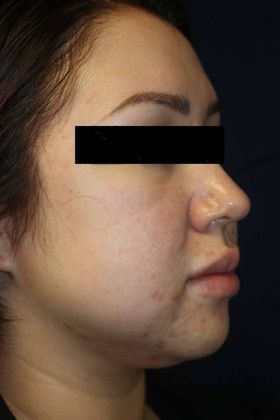 Neck Sculpting : Case 1 - Before