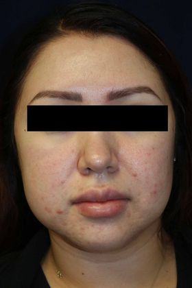 Neck Sculpting : Case 1 - Before