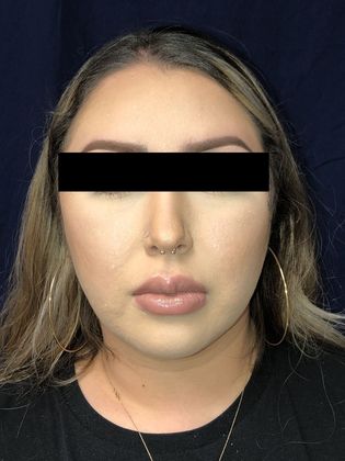 Neck Sculpting : Case 1 - After