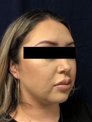 Neck Sculpting : Case 1 - After