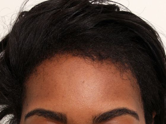 Hair Transplant - Female: Traction Alopecia (6) - After traction alopecia hair transplant