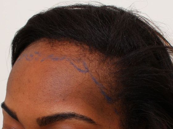 Hair Transplant - Female: Traction Alopecia (6) - Before traction alopecia