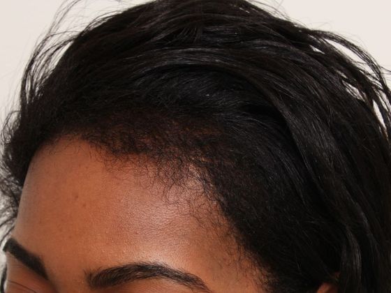 Hair Transplant - Female: Traction Alopecia (6) - After traction alopecia hair transplant